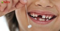 Nằm mơ thấy gãy răng là điềm gì?